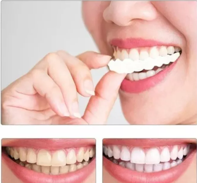 Carillas Dentales