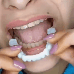 Carillas Dentales