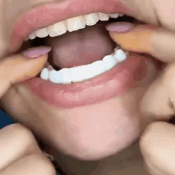 Carillas Dentales