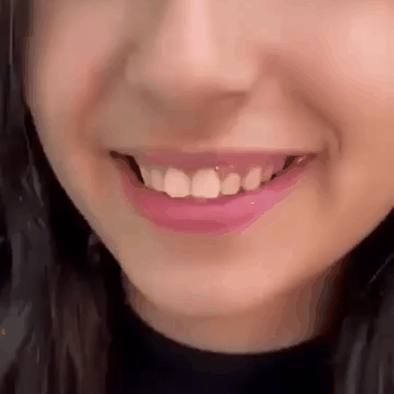 Carillas Dentales